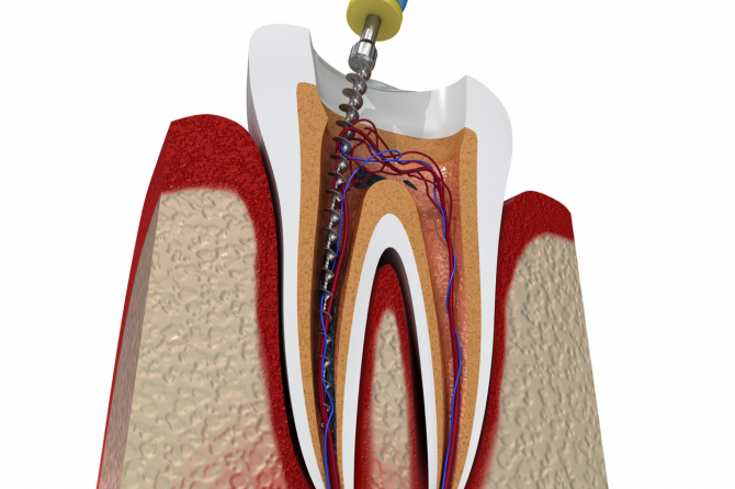 Când apelăm la scoaterea nervului? Tratamentul endodontic la care apelăm doar în anumite situații